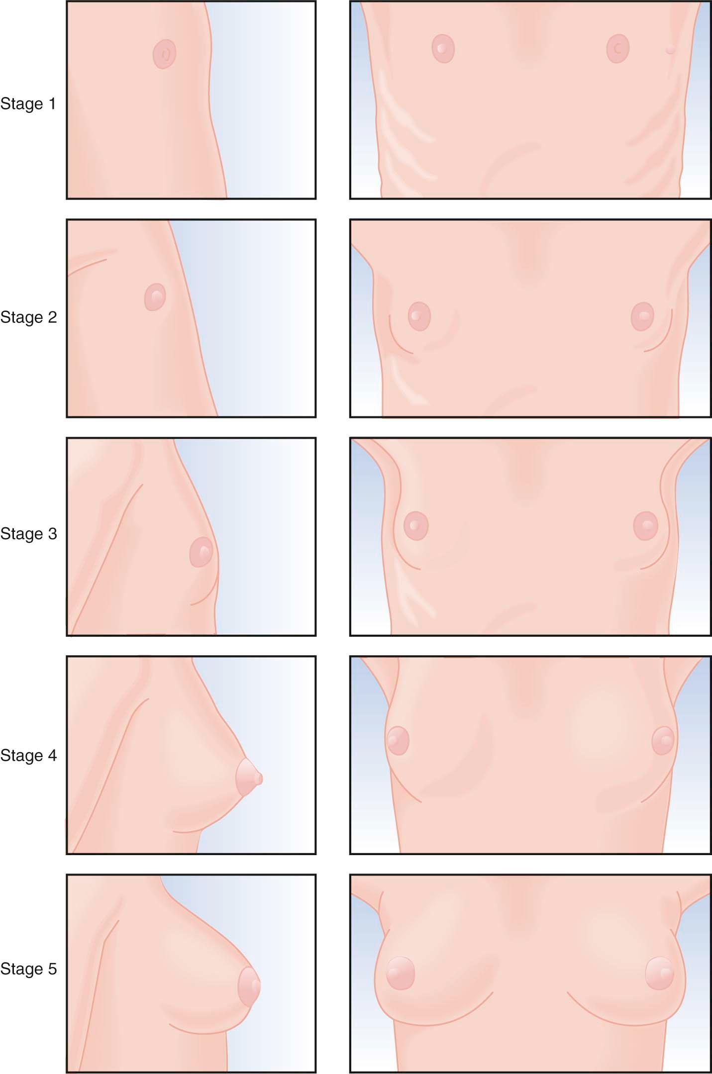 FIGURE 32-3, Stages of breast development as defined by Marshall and Tanner. Stage 1, Preadolescent; elevation of papilla only. Stage 2, Breast bud stage; elevation of breast and papilla as a small mound with enlargement of the areolar region. Stage 3, Further enlargement of breast and areola without separation of their contours. Stage 4, Projection of areola and papilla to form a secondary mound above the level of the breast. Stage 5, Mature stage; projection of papilla only, resulting from recession of the areola to the general contour of the breast.