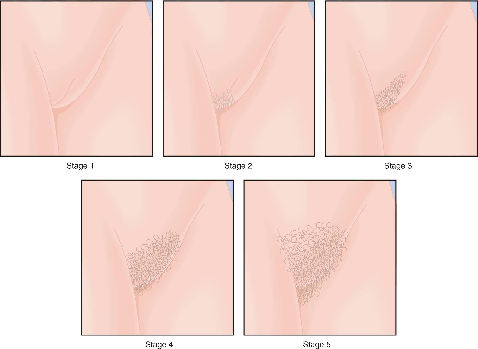 FIGURE 32-4, Stages of female pubic hair development according to Marshall and Tanner. Stage 1, Preadolescent; absence of pubic hair. Stage 2, Sparse hair along the labia; hair downy with slight pigmentation. Stage 3, Hair spreads sparsely over the junction of the pubes; hair is darker and coarser. Stage 4, Adult-type hair; no spread to the medial surface of the thighs. Stage 5, Adult-type hair with spread to the medial thighs assuming an inverted triangle pattern.