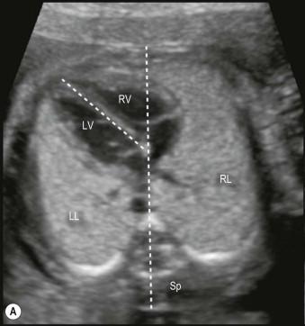 FIGURE 15-1, (A) Size and appearance of the lungs and the position of the heart with an axis of 45° to the left are best seen in the plane of the four-chamber-view of the heart in this 21-week fetus. (B) The upper mediastinum is assessed at the level of the three-vessel-trachea-view. Thymus (Thy) is recognized between sternum and great vessels. Sp: spine; AO: aorta; PA: pulmonary artery; LV: left ventricle; RV: right ventricle; LL: left lung; RL: right lung.