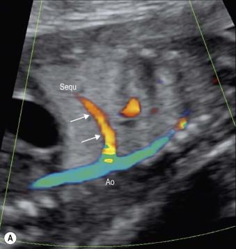 FIGURE 15-11, (A) Parasagittal view of the fetus in Figure 15-10 with a hyperechogenic lung lobe due to a bronchopulmonary sequestration. The mapping of the lung systematically with the colour Doppler box revealed a large feeding artery (arrows) directly arising from the thoracic descending aorta (Ao). (B) Pulsed Doppler interrogation of this artery showed the typical pulsatile flow in bronchopulmonary sequestration (Sequ).