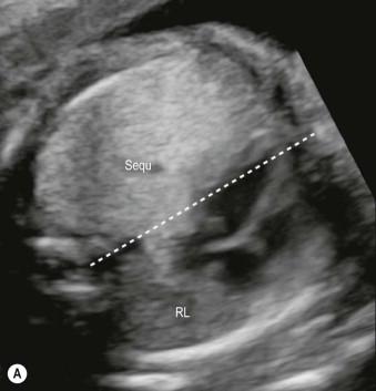 FIGURE 15-12, This is a comparison of shifting of the heart and hyperechogenicity in a fetus with lung sequestration examined at 22 weeks (A) and at 29 weeks (B). At 22 weeks there is a significant difference in echogenicity between both lungs and the heart is shifted to the right. The right lung (RL) appears small. Less than 2 months later, the hyperechogenicity is reduced or has resolved, the heart is then in a more typical position and there is no suspicious finding. The feeding artery was still present and the child had to be operated after birth.