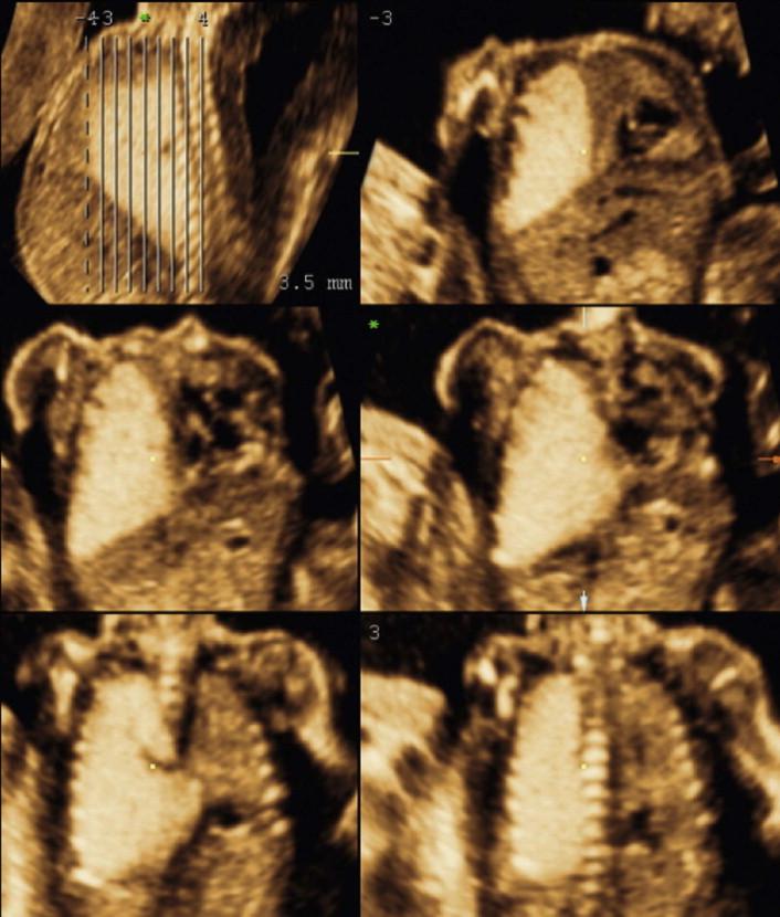 FIGURE 15-13, Lung sequestration demonstrated with three-dimensional ultrasound with tomographic display in coronal views. Tomography provides an overview of the lesion extent and the relationship to the neighbouring organs.