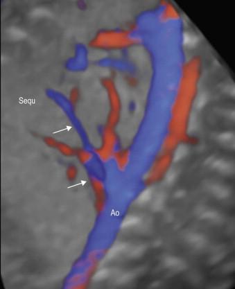 FIGURE 15-14, Three dimensional rendering of a lung sequestration (Sequ) with the feeding artery arising from the descending aorta (Ao) demonstrated in the ‘glass-body mode’ which provides a general view of the spatial course of the vessel.