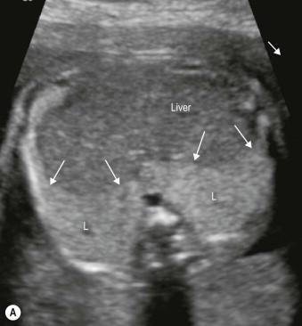 FIGURE 15-2, Fetal lungs (L) appear slight echogenic in comparison to the liver. The difference of echogenicity and the diaphragm (arrows) can be visualized either in (A) a cross-section of the upper abdomen at the transition to the chest or in (B) a parasagittal view here on the right side with the cone-shaped lung. The upper border of the lung is the clavicle level (Clav.).