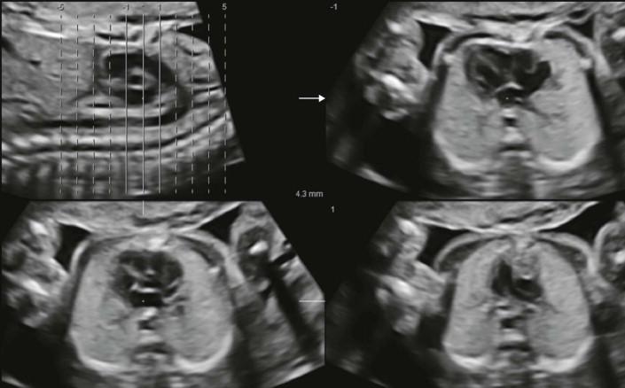 FIGURE 15-3, Demonstration of the fetal chest by three-dimensional ultrasound with tomographic display. This can be displayed for example as parallel axial views as usually seen during live scanning (compare with Figure 15-4 ).