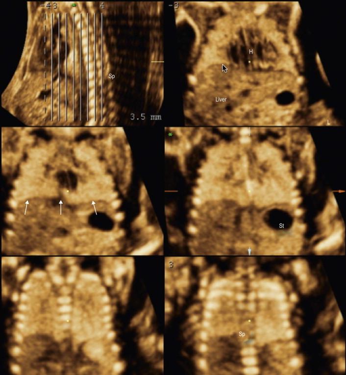 FIGURE 15-4, Demonstration of the fetal chest by three-dimensional ultrasound with tomographic display. This can be demonstrated either as an antero-posterior or coronal view. Sp: spine; H: heart; St: stomach. Arrows show the diaphragm border.