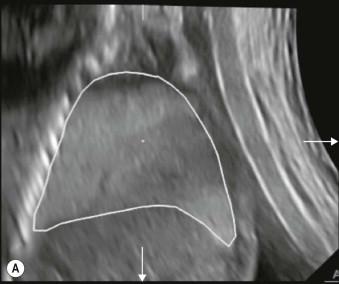 FIGURE 15-5, Three dimensional ultrasound can occasionally be used to measure the volume of one lung lobe or structure of interest. After drawing the line around the outer limit of the lung (A) and completing measurements by rotating the volume, the software displays the lung shape and provides the calculated volume (B). In this case the software used was the Virtual Organ Computer-aided AnaLysis (VOCAL ®).