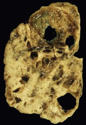 FIGURE 15-9, Autopsy specimen of a macrocystic lung with large and small cysts in a CCAM, presenting with fetal hydrops at 20 weeks