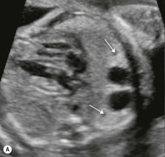 FIGURE 15-6, Congenital cystic adenomatoid malformation (CCAM) of the inferior right lung lobe. This is a macrocystic type of CCAM seen in the axial (A) and parasagittal (B) planes. Adjacent to these cysts there is often an echogenic area (arrows) suggesting the presence of microcysts.