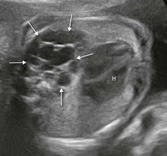 FIGURE 15-7, This fetus was referred with a macrocystic congenital cystic adenomatoid malformation of the upper left lung with multiple cysts (arrows) and mild heart (H) displacement anteriorly and to the right.