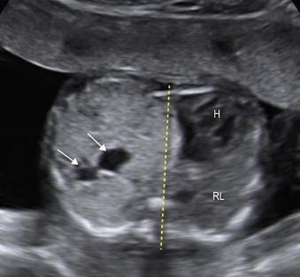 FIGURE 15-8, In this fetus there is a large congenital cystic adenomatoid malformation mainly of microcystic type. The presence of two small echolucent cysts (arrows) supports the diagnosis. Colour Doppler excluded the main differential diagnosis of a lung sequestration. There is a significant shifting to the right and there is a risk that the right lung (RL) is hypoplastic. H: Heart.