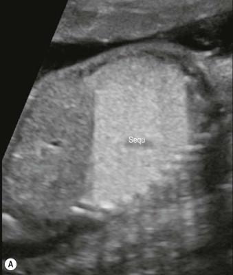 FIGURE 15-10, In this fetus (A) the parasagittal view shows a hyperechogenic lung lobe and (B) the axial plane shows the enlarged size of this lung lobe with shift of the heart to the right. Normal echogenicity of the right lung (RL) can be used as comparison. Colour Doppler (see Figure 15-11 ) revealed the diagnosis of lung sequestration (Sequ).