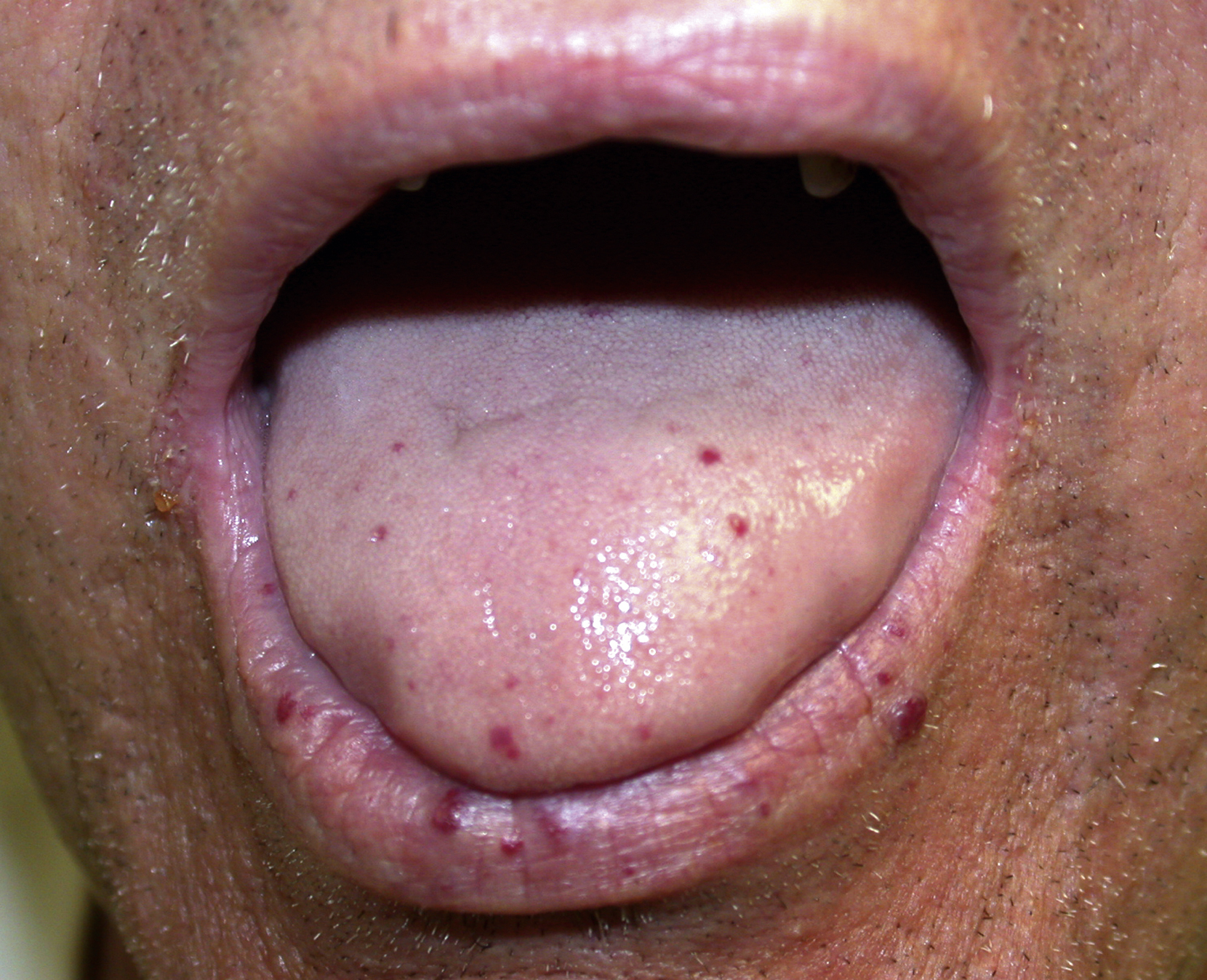 Fig. 54.1, Multiple telangiectases on the tongue and lips in a patient with hereditary hemorrhagic telangiectasia.