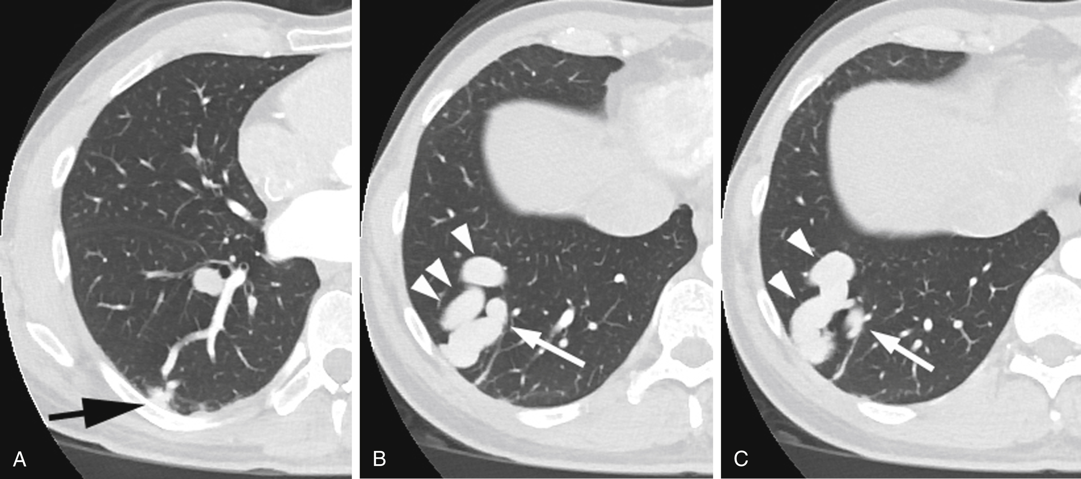 Fig. 54.3, Computed tomographic scans showing multiple pulmonary arteriovenous malformations (PAVMs)in a patient who presented with stroke and was subsequently diagnosed with hereditary hemorrhagic telangiectasia. (A) A small simple PAVM in the right lower lobe superior segment ( arrow ), with its feeding artery located anteromedially and the draining vein anterolaterally. (B) and (C) A large simple PAVM in the right lower lobe lateral segment with its feeding artery ( arrows ) and feeding vein ( arrowheads ).