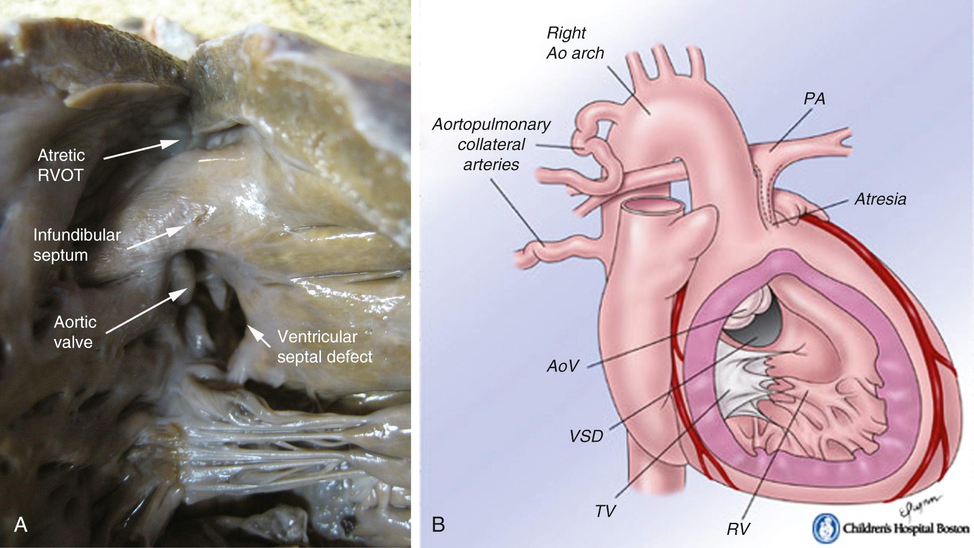 FIGURE 120-1, Anatomic specimen and schematic demonstrating the features of pulmonary atresia with ventricular septal defect. Ao, Aortic; AoV, aortic valve; PA, pulmonary artery; RV, right ventricle; RVOT, right ventricular outflow tract; TV, tricuspid valve; VSD, ventricular septal defect.