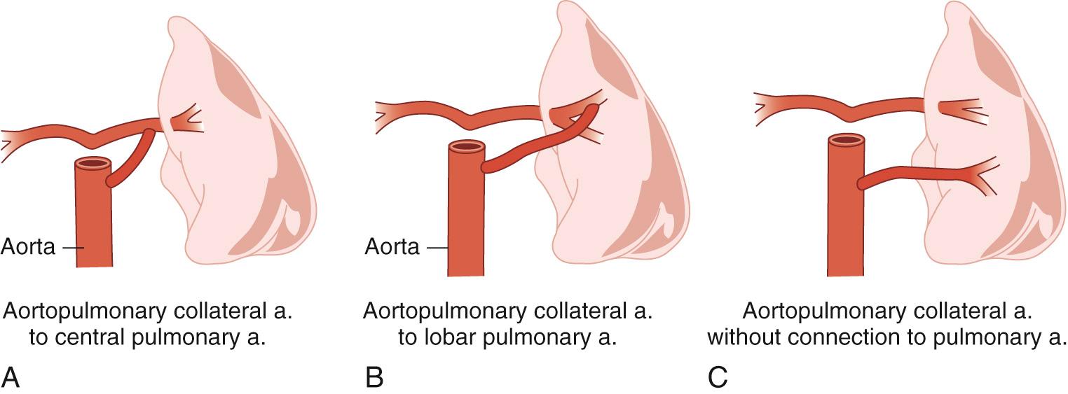 FIGURE 120-2, Variations in aortopulmonary collateral morphology in pulmonary atresia with ventricular septal defect.