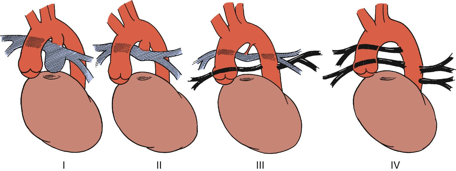 FIGURE 120-3, Variations in pulmonary supply from native pulmonary arteries (hatched gray) and major aortopulmonary collateral arteries (solid black) encountered in patients with pulmonary atresia with ventricular septal defect.