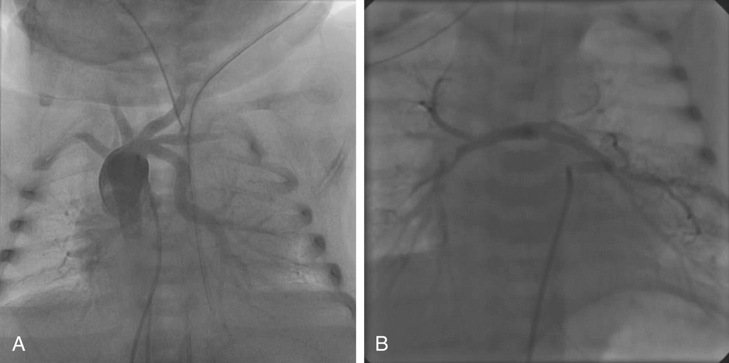 FIGURE 120-4, Angiograms demonstrating major aortopulmonary collateral artery to left lung (A) and redundant collateral to left lung also supplied by hypoplastic native pulmonary arteries (B).