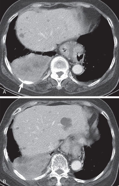 Fig. 18.1, T4 squamous cell carcinoma with surgically proven chest wall and right hemidiaphragmatic invasion. (A) CT scan obtained at level of liver dome shows enhancing, heterogeneous mass in the right lower lobe, abutting the chest wall. Erosion of a posterior right rib (arrow) indicates chest wall invasion. (B) CT scan obtained 15 mm caudal to (A) demonstrates overt chest wall and probable right hemidiaphragmatic invasion.