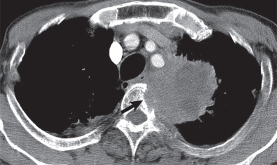 Fig. 18.2, T4 large-cell lung cancer. Contrast-enhanced axial CT scan obtained at the level of the great vessels shows a large left upper lobe heterogeneous mass invading the adjacent vertebral body (arrow) .