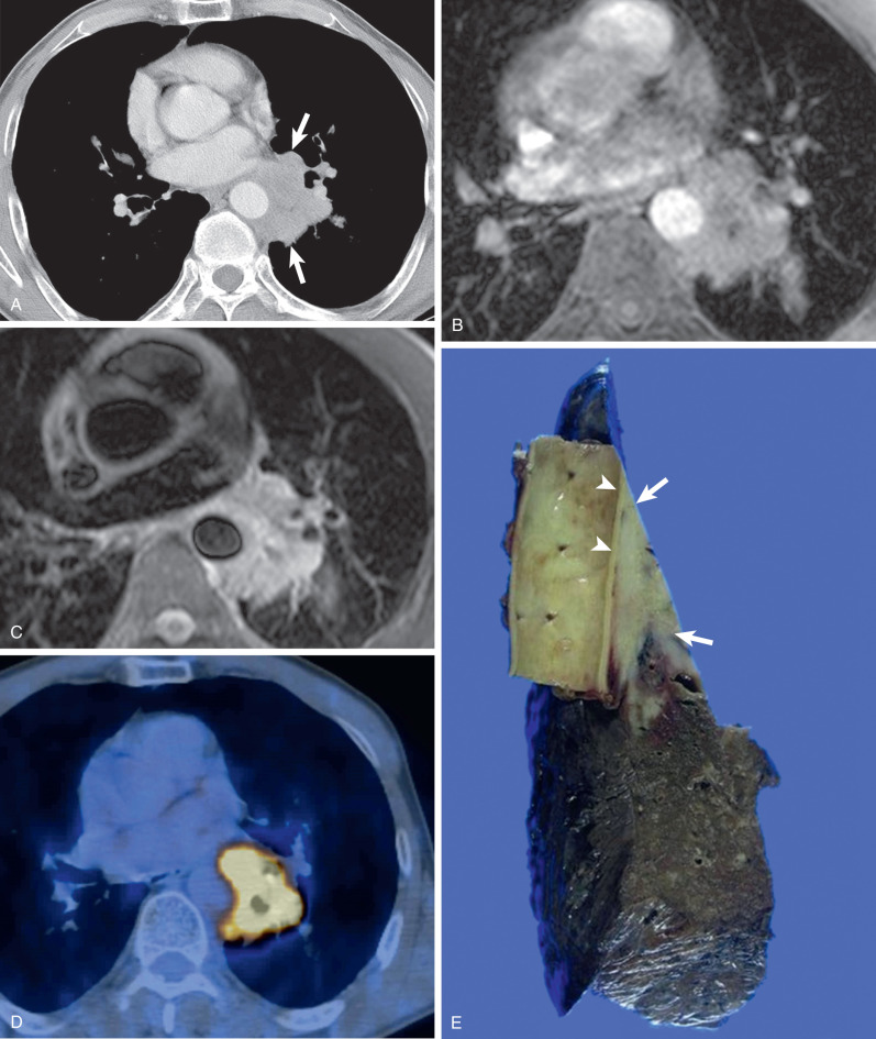 Fig. 18.3, T4 squamous cell lung cancer showing descending thoracic aortic invasion. (A) Contrast-enhanced CT scan obtained at left atrial level shows a mass (arrows) in the superior segment of the left lower lobe partially encircling the descending thoracic aorta over about 180 degrees of the aortic circumference. (B) and (C) T1W turbo-field-echo (B) and T2W triple inversion black-blood (C) MR images show the high-signal intensity mass abutting descending thoracic aorta over approximately 180 degrees. (D) Integrated PET-CT shows tumor with high FDG uptake abutting aorta over about 180 degrees. (E) Gross pathologic specimen shows that tumor (arrows) has invaded into the aortic adventitia (arrowheads). Microscopic examination (not shown here) confirmed aortic invasion.