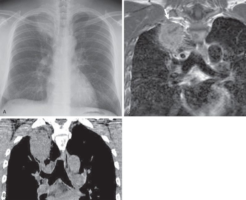 Fig. 18.4, Superior sulcus tumor (adenocarcinoma). (A) Chest radiograph shows a large mass in the right upper lung zone. (B) Coronal-reformation CT image shows an oval mass in the right upper lobe. (C) Enhanced coronal T1W MR image shows a heterogeneously enhancing mass in the right upper lobe with focal penetration (arrow) of extrapleural fat, consistent with chest wall invasion.