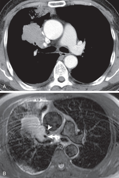 Fig. 18.5, Contrast-enhanced CT image compared with MR image in a 71-year-old man with large cell neuroendocrine carcinoma. (A) Contrast-enhanced axial CT scan obtained at the level of the right upper lobar bronchus shows a mass lesion in the right upper lobe with post–obstructive pneumonia. (B) Axial T2W triple inversion black-blood MR image obtained at similar level to (A) demonstrates a right upper lobe mass and accompanying post–obstructive pneumonia. Tumor encircles the truncus anterior (arrow), but the superior vena cava (arrowhead) appears to be intact.