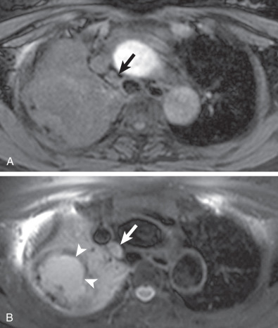 Fig. 18.6, MRI in squamous cell lung carcinoma. (A) T1W turbo-field-echo MR image shows an intermediate signal intensity lesion in the right upper lobe. Also note enlarged lymph node (arrow) in the lower right paratracheal station. (B) T2W triple inversion black-blood MR image shows a lung mass (arrowheads) and surrounding atelectatic right upper lobe. Also note enlarged right paratracheal lymph node (arrow) with high signal intensity. Patient had proven T2N2 lung cancer.