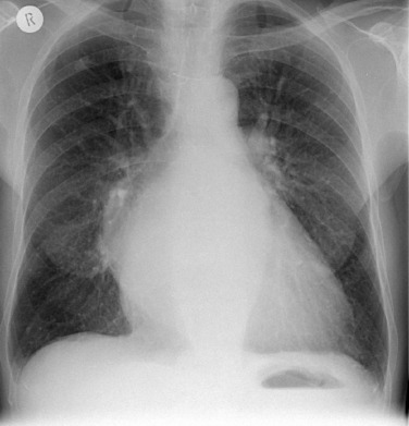 Fig. 16.1, Upper Lobe Venous Diversion.