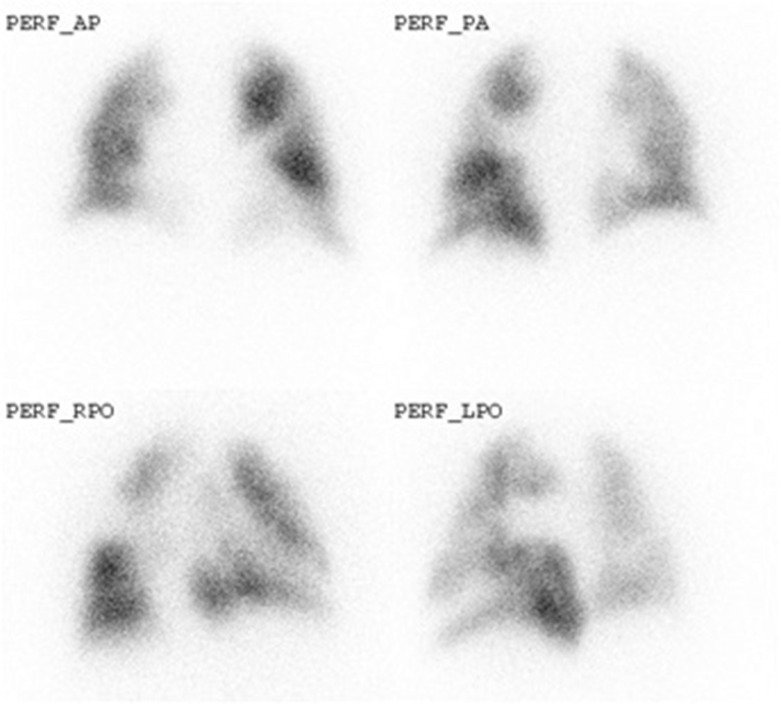 Fig. 16.11, Perfusion scintigram in a patient with chronic thromboembolic pulmonary hypertension showing patchy, irregular distribution of the tracer with multiple small and medium-sized perfusion defects.