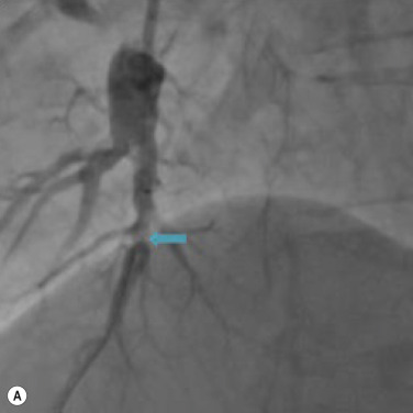 Fig. 16.12, Pulmonary angioplasty in a patient with chronic thromboembolic pulmonary hypertension. (A) TEPHSubsegmental web causing significant stenosis (blue arrow) , which (B) post balloon angioplasty has resolved (green arrow) .