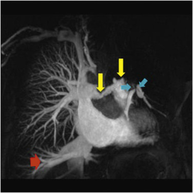 Fig. 16.13, Maximum intensity projection of spatially resolved magnetic resonance demonstrating laminated thrombus (yellow arrows) , causing severe stenosis of the right main pulmonary artery and occlusion of most left-sided segments with tight webs (blue arrows) in the remaining perfused segments of the left lower lobe. Occlusion of a hepatic vein (red arrow) is noted in keeping with tricuspid regurgitation.