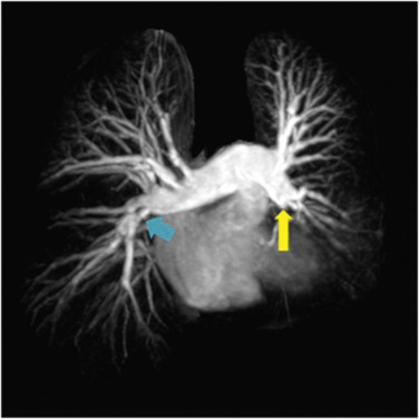 Fig. 16.14, Maximum intensity projection image from spatially resolved magnetic resonance showing occlusion (yellow arrow) of the left lower lobe and complex web (blue arrow) in the right lower lobe in a patient with proximal chronic thromboembolic pulmonary hypertension.