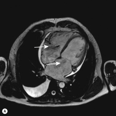 Fig. 16.15, Magnetic Resonance Imaging of the Heart Showing the Regurgitation Jet (Arrows) in Both Atria Due to Tricuspid and Mitral Valve Insufficiency.