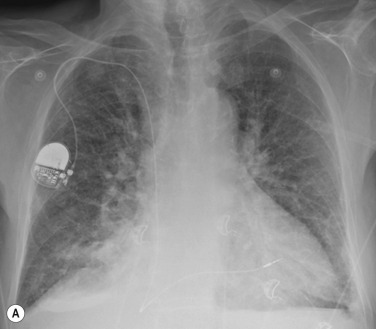 Fig. 16.2, Interstitial Oedema.