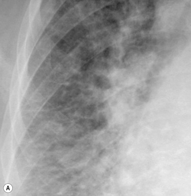 Fig. 16.3, Interstitial Oedema. PA (A) and lateral (B) chest radiographs show thickened interlobular septa in (A) versus the opacification ranging from ground-glass to dense consolidation in (B).