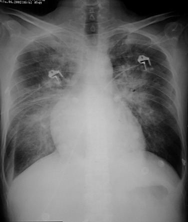 Fig. 16.4, Alveolar Pulmonary Oedema.