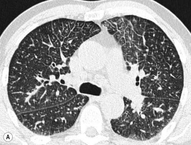 Fig. 16.5, Interstitial oedema (A) is characterised by thickened interlobular septa and focal areas of increased density. Alveolar oedema (B) causes dense consolidations which can be diffuse or more patchy in distribution. The subpleural area may be spared.