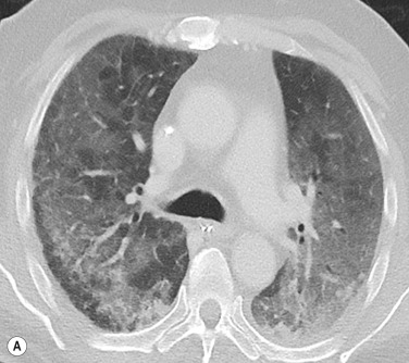 Fig. 16.6, Two Patients With Alveolar Oedema.