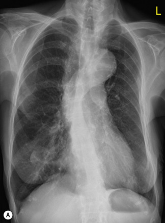 Fig. 16.7, Patient with severe chronic obstructive pulmonary disease without (A) and with (B) signs of pulmonary fluid overload and cardiac decompensation. Note the only discrete increase of vascular markings in (B) while the pleural effusion and the enlarged heart indicate the severity of disease.