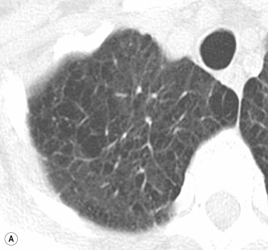 Fig. 16.8, Corresponding computed tomography images in the same patient as Fig. 16.7 show severe centrilobular emphysema without (A) and with (B) increased septal thickening due to fluid overload but no consolidation.