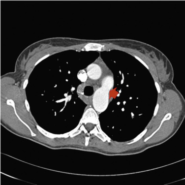 Fig. 16.9, Computed tomography shows large patent ductus arteriosus between left pulmonary artery and aorta (red arrow) resulting in a left-to-right shunt and severe pulmonary hypertension with dilated and hypertrophied (blue arrow) right ventricle.