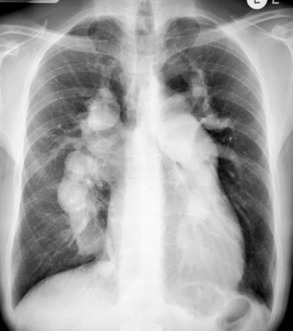 Fig. 16.10, Pulmonary Arterial Hypertension With Massively Enlarged Pulmonary Arteries.