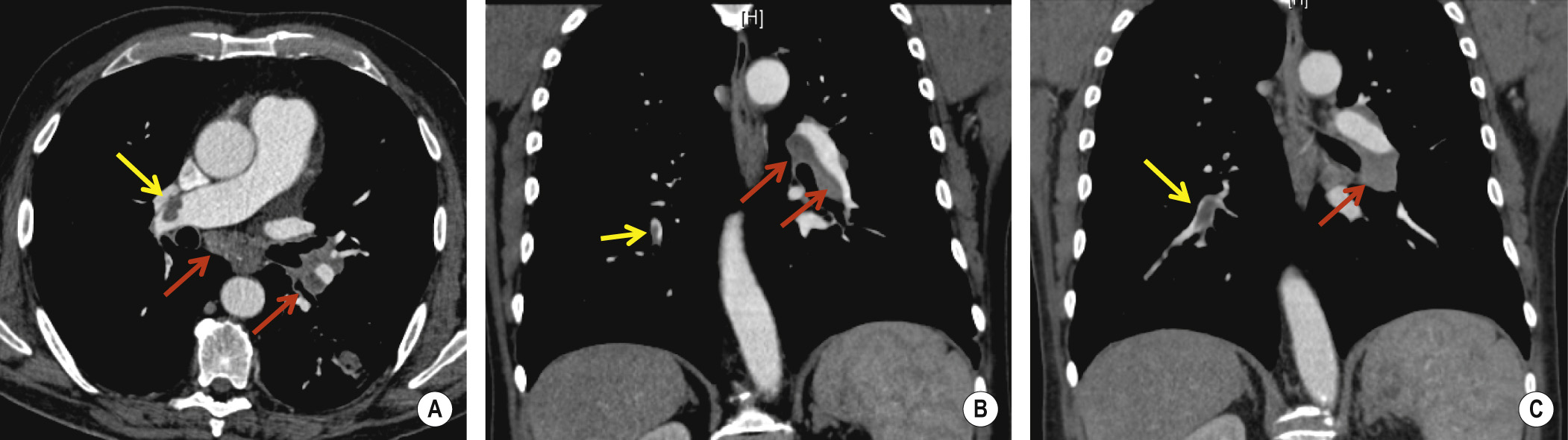 (A) Central thrombus (yellow arrow) with smooth margins, centrally located and acute angles with the vessel wall, and lymphadenopathy (red arrows). Coronal reconstructions (B, C) may aid in the differentiation between endoluminal clots (yellow arrows) and lymphadenopathy (red arrows). Note the central position of the clot surrounded by contrast medium. **