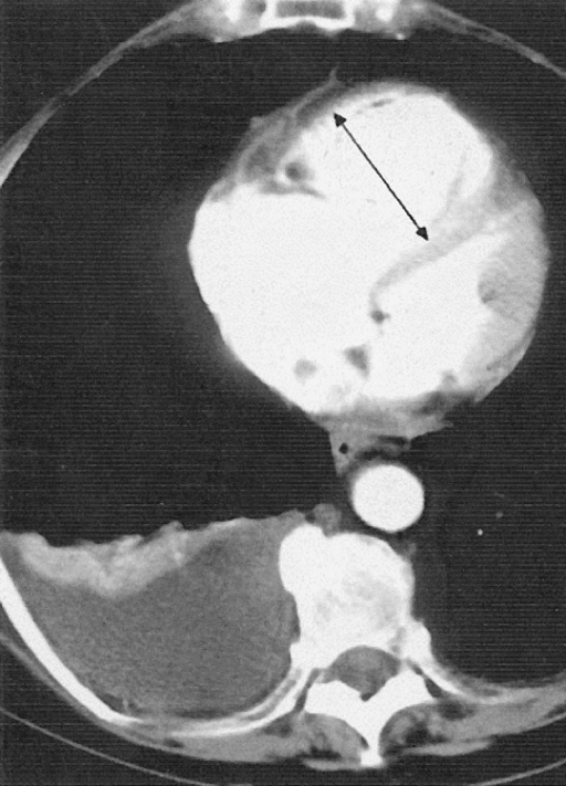 CTPA identifying additional features that can be detected supporting a diagnosis of pulmonary embolism. There is a right-sided pleural effusion and dilatation of the right ventricle (arrow). †