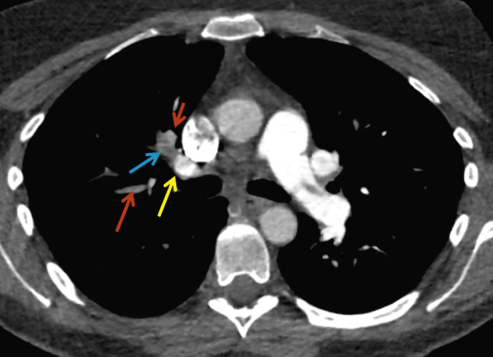 Beam-hardening artefact in the right upper lobe pulmonary artery (yellow arrow) due to dense contrast medium in the superior caval vein. Thrombus (blue arrow) more peripherally. Red arrows, non-opacified pulmonary veins. **