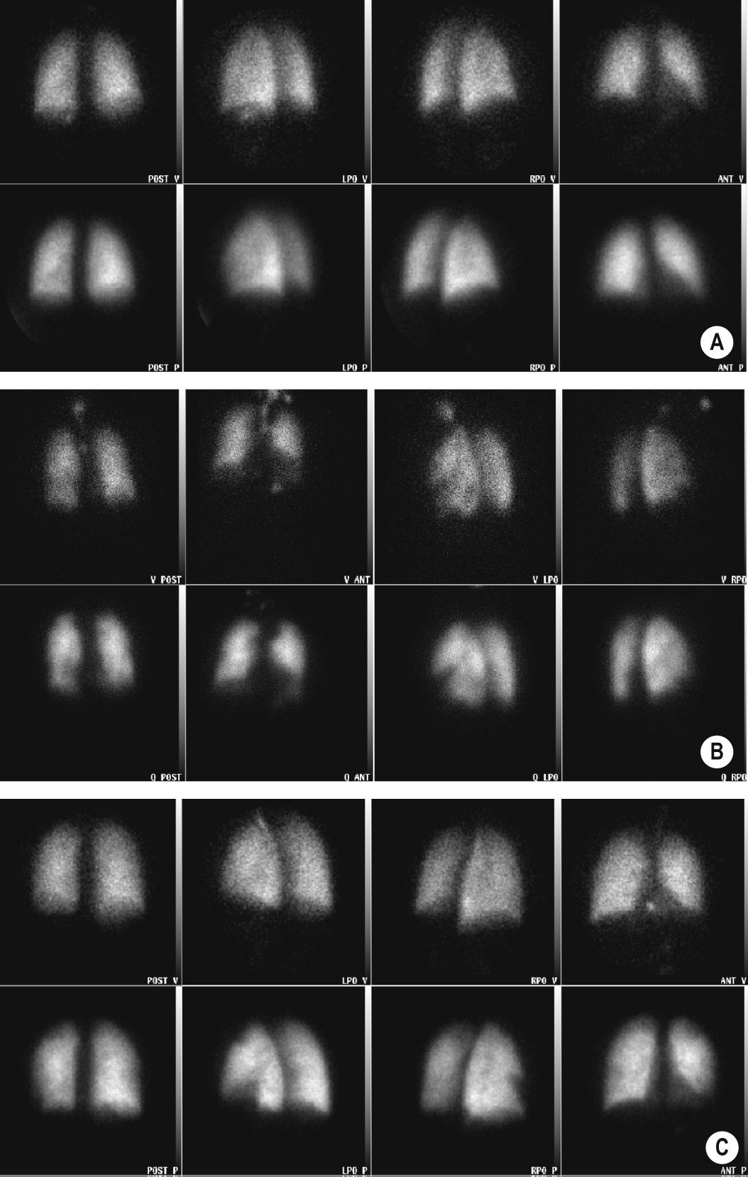 Pulmonary thromboembolism. (A) Normal V/Q study (ventilation (v) images on top row and perfusion (p) images beneath). No defects are seen in either series. (B) Matched defects – multiple foci of non-tracer uptake seen in ventilation and perfusion series. Scrutiny of the images reveals that the defects are well matched for position on both series. (C) Perfusion defect (wedge-shaped peripherally) seen on perfusion imaging which is not replicated on ventilation imaging. This suggests a high probability for the presence of pulmonary embolus. *