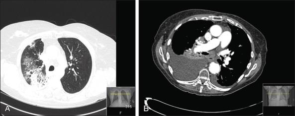 Figure 47.1, Case examples of radiation pneumonopathy. (A) This patient was treated with concurrent chemoradiotherapy (45 Gy) for limited stage small cell lung cancer. About 2 months after treatment, she presented with cough and mild dyspnea on exertion (grade 2 by Common Terminology Criteria version 4 [CTCv4] criteria). Imaging showed infiltrates as shown; these corresponded quite precisely to the irradiated volume (inset) . Of note, a positron emission tomography scan shows moderately increased fluorodeoxyglucose uptake. The patient's symptoms responded dramatically to steroids. (B) This patient was treated with concurrent chemoradiotherapy (63 Gy) for stage III non–small cell lung cancer of the right upper lobe, hilum, and mediastinum. The tumor responded well, but about 6 months after treatment, progressive opacification of the right hemithorax was noted, along with pleural effusion. Symptoms, including dyspnea and cough, were grade 2 by CTCv4 criteria and improved with steroids but worsened when steroids were tapered. The decision was made to proceed with an exploratory thoracoscopy, both for diagnostic purposes (to rule out recurrent tumor) and therapeutic purposes (pleurodesis). Pathology showed no viable tumor, only intense inflammation and evolving fibrosis. Pleurodesis was successful. The patient continues monitoring and treatment with intermittent oxygen and steroids and antibiotics for acute exacerbations of symptoms.