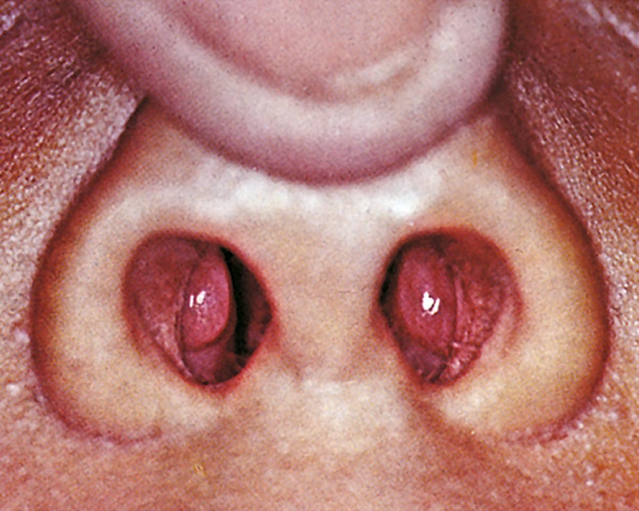 Fig. 17.2, Cystic fibrosis. Nasal polyps in a patient with cystic fibrosis.