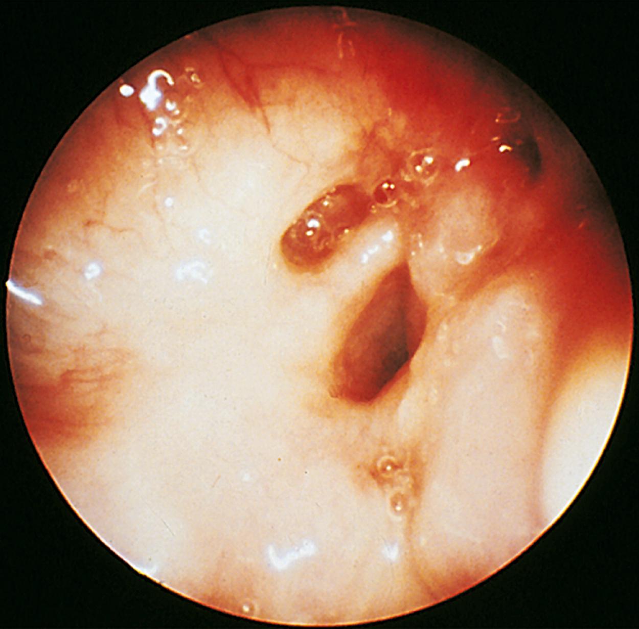 Fig. 17.3, Laryngeal web. Expiratory view of a laryngeal web in an infant with inspiratory stridor that was exaggerated by crying noted at birth. The web is seen traversing the area of the glottis.